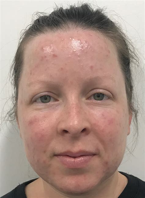 Rosacea Treatment | Fairview Dermatology