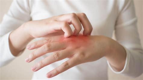 Pay attention to allergic eczema during seasonal changes – Kimdeyir