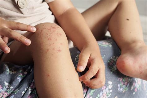 Hand Foot Mouth Disease On Legs