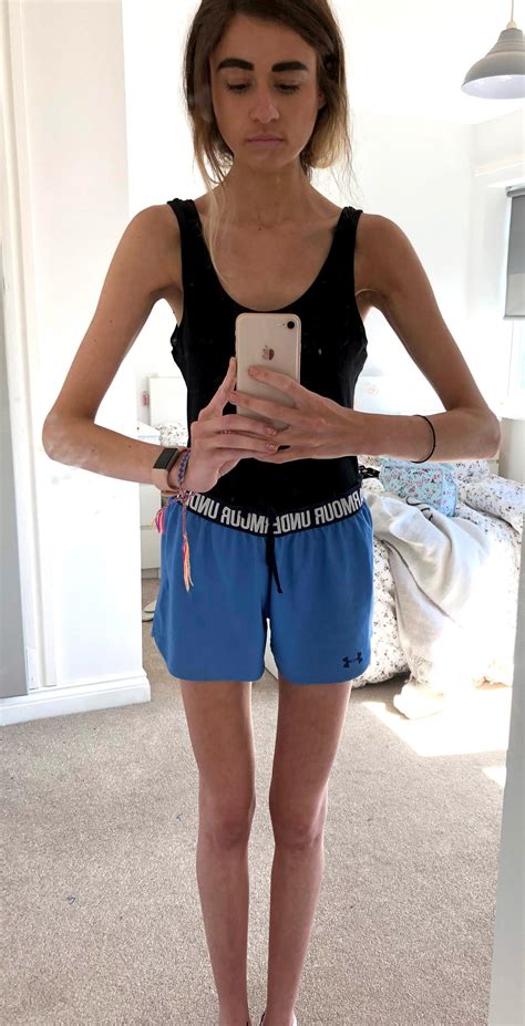 Anorexic Female