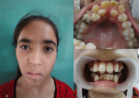 Marfan Syndrome Face