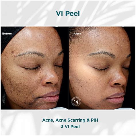 vi peel treatment  thousand oaks ca glow aesthetic center