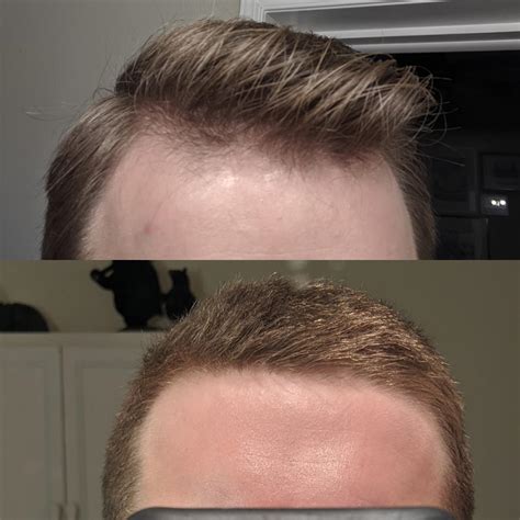 6 Month Hair Progress/Growth (Full Imgur Album in comments) : r/tressless