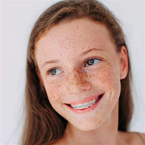 Help! Will Braces for My Overbite Fix My Teeth?