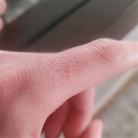 Is this a bat bite? : r/BAT