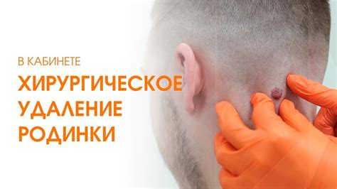 Удаление родинок хирургическим путём / Удаление невуса на голове - YouTube