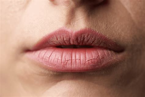 Labios Rachados O Que Passar - Lábios Rachados no Inverno: Como Prevenir, Tratar e Evitar o ...