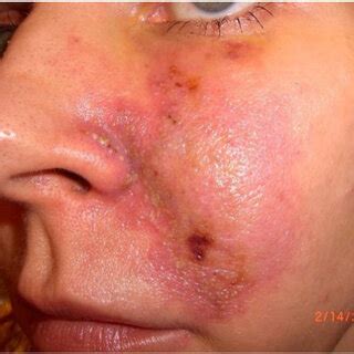 Formation of pustules on the nose and a full thickness defect near the ...