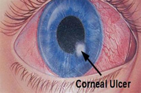 Corneal Disease