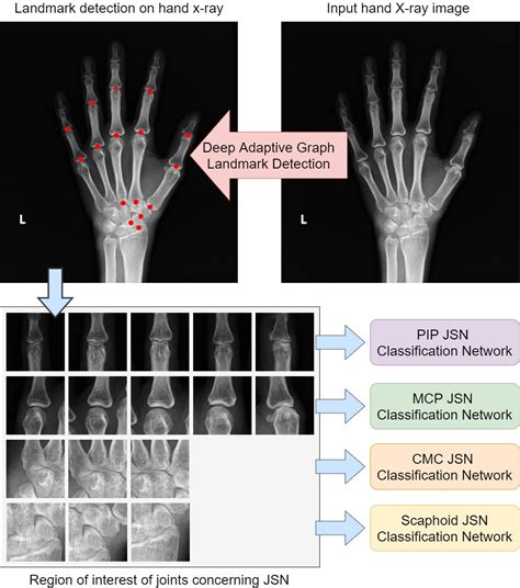 Automatic Joint Space Assessment in Hand Radiographs with Deep Learning ...