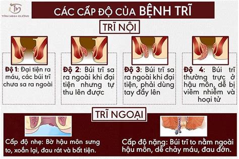 Bệnh trĩ ở người cao tuổi