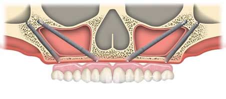 Zygomatic Implants | Ramsey A. Amin, DDS