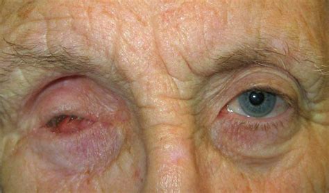 Upper eyelid entropion - New Zealand Prosthetic Eye Service