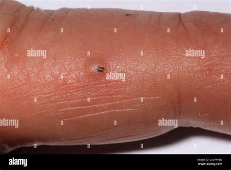 splinter patient   wood splinter   finger  skin