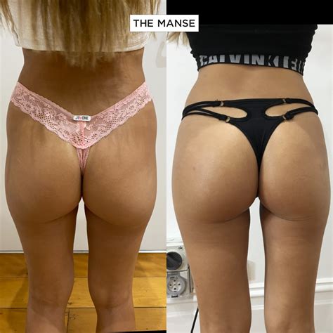 Best Filler For Hip Dips at Samantha Atherton blog