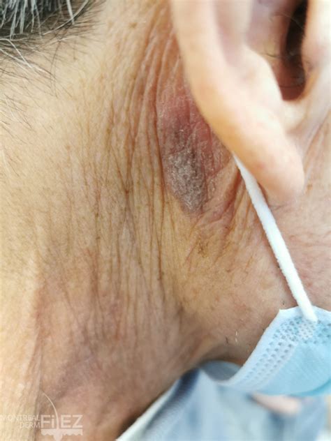 Lichen Planus and Lichenoid Dermatoses Gallery – Montreal Derm FilEZ