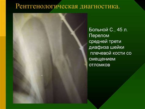 Повреждение плеча, вывихи плеча и предплечья - презентация онлайн