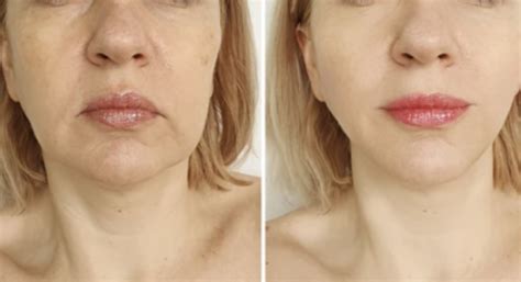 Face Lift – Trip for Aesthetics