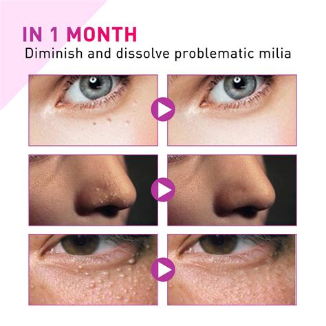 milia bumps on face 10