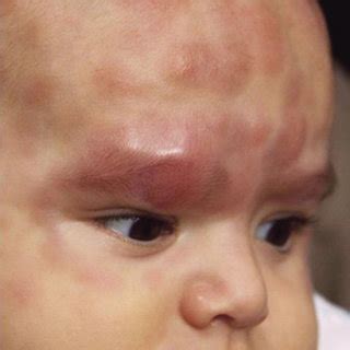 multiple erythematous nodules   sizes disseminated