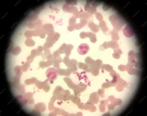 Esfregaço de sangue microscópico mostra leucocitose neutrofílica e trombocitose | Foto Premium