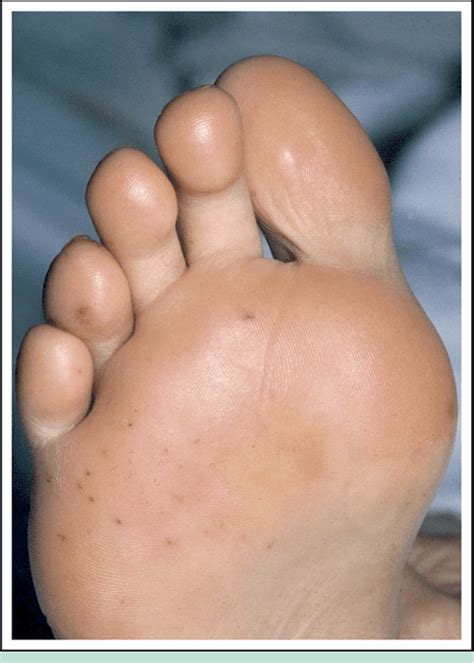 Osler's nodes and Janeway lesions. | Semantic Scholar