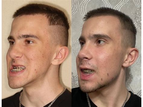 Мезиальный прикус: случай успешного комплексного лечения — Заболевания ...