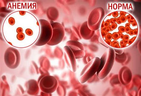 Анемія: причини, діагностика, лікування | довідник хвороб
