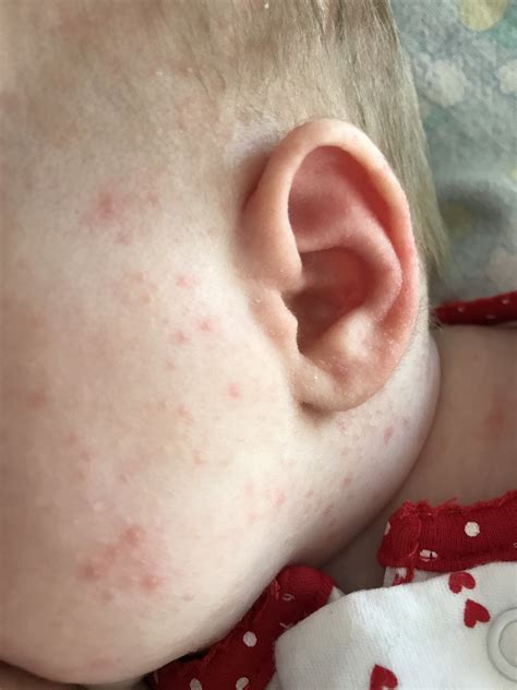 Blackheads Behind Ear