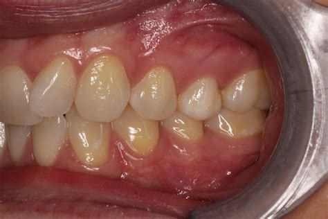 Aligner Treatment Clinical Cases - Acura Aligner Solutions