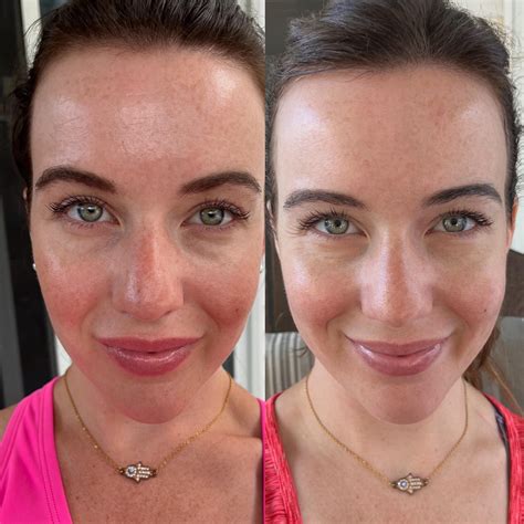 Weight Loss Red Light Therapy Before And After Cellulite at Michael ...