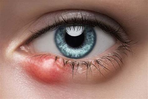 Stye treatment - Harvard Health