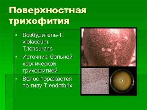 Микозы волосистой части головы Поверхностная трихофития
