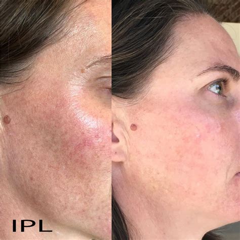 Before and After – Skin Essentials