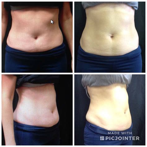 Non Surgical Body Sculpting - Round Rock TX