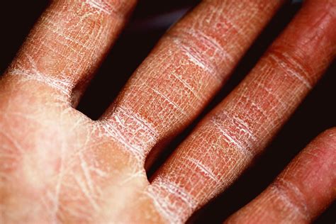 Экзема на руках: симптомы профилактика и лечение - Health 24