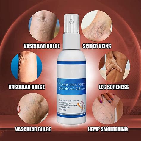 how to fix varicose veins