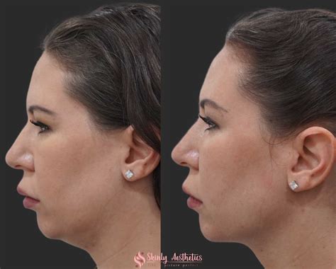 kybella      expect  injectable fat reduction