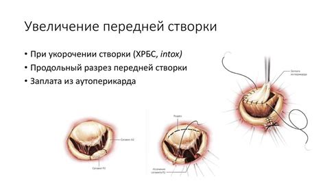 Приобретённые пороки митрального клапана - презентация онлайн