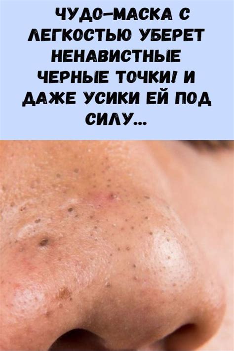 How to Know Your Skin Type to Care Better | Черные точки, Лицо, Угри