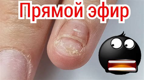 ТРЕШ! Ремонт Сорванного Ногтя. Комби Маникюр. Прямой Эфир Виктория ...