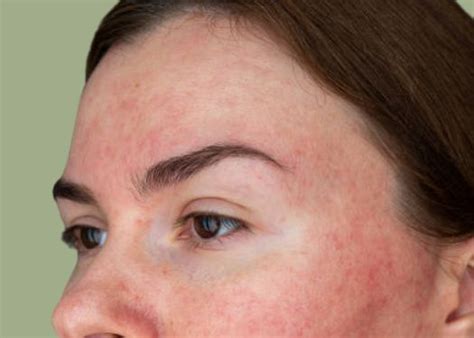 Skin condition-Redness and Rosacea - Skindevour