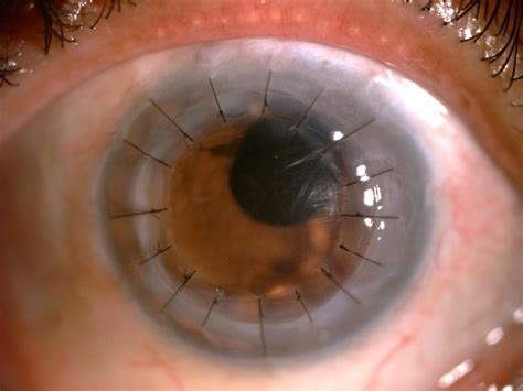 Corneal Transplant - Amritsar Eye Clinic