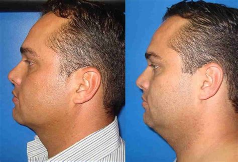 como quitar la papada rapido