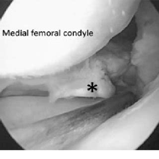 McMurray test was performed by rotation and extension of a flexed knee ...