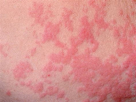 What Causes Hives? 7 Possible Triggers - GoodRx