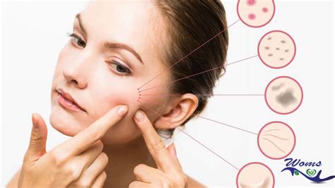 top  organic remedies  home remedies  pimples woms