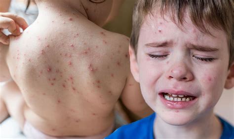 chickenpox frenzy  calamine runs   options