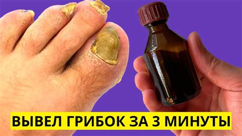 Грибок Ногтей Исчезнет За 3 Минуты, Если Применять Этот Способ! Лечение ...