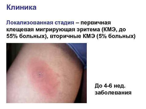 Лайм-боррелиоз системный клещевой боррелиоз болезнь Лайма Иксодовые